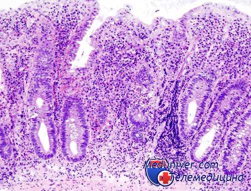 множественный рак тонкой кишки