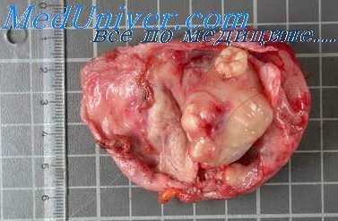 канцерогенез