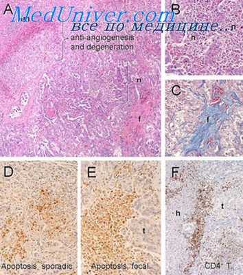 радиационная опухоль