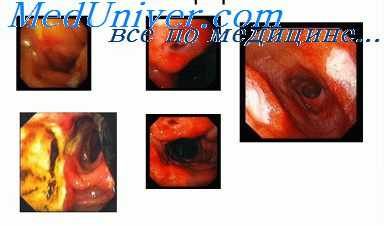 язвенная болезнь желудка