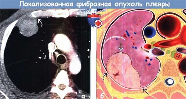 Локализованная фиброзная опухоль плевры (ЛФОП) на КТ