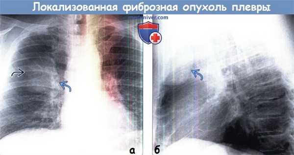 Локализованная фиброзная опухоль плевры (ЛФОП) на рентгенограмме