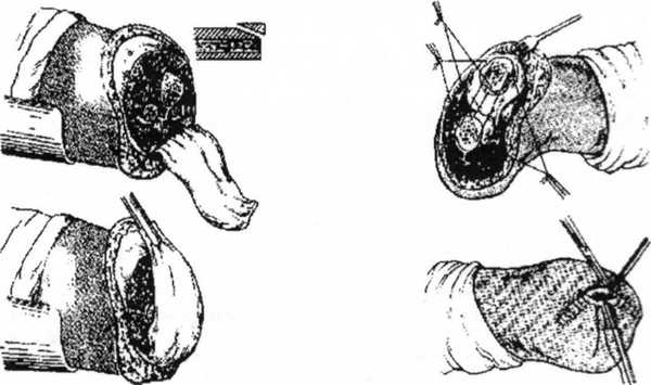 Ампутация нижних конечностей