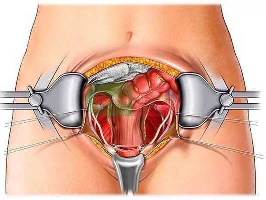 лапаротомическая операция в москве