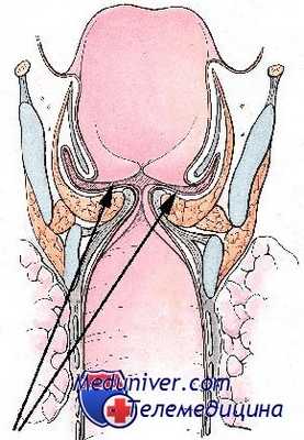 ложная фонастения