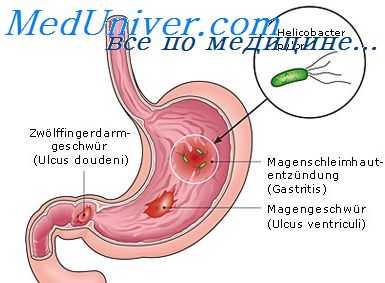 язвенный колит