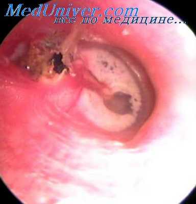 удаление молоточка