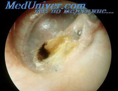 холестеатома