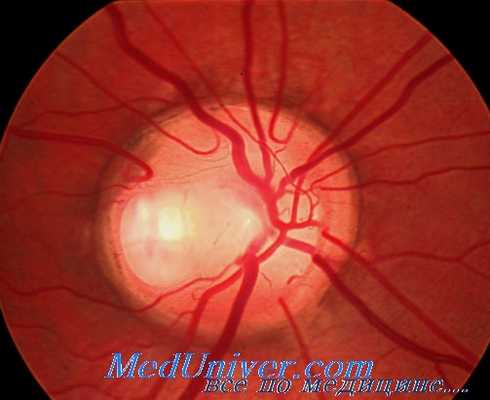 побледнение соска зрительного нерва