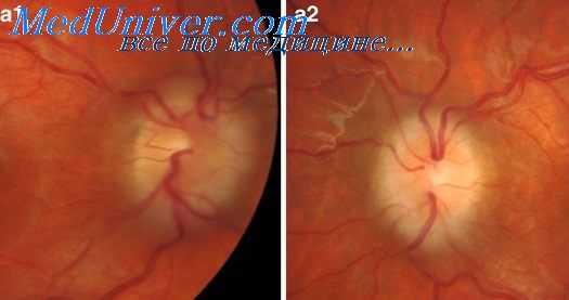 ложный неврит зрительного нерва