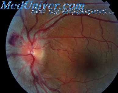 оценка зрительного нерва