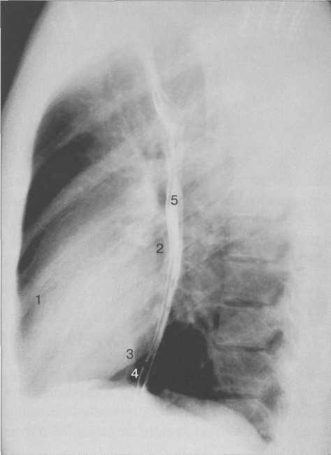 Рентгенограмма грудной клетки. Левая боковая проекция.