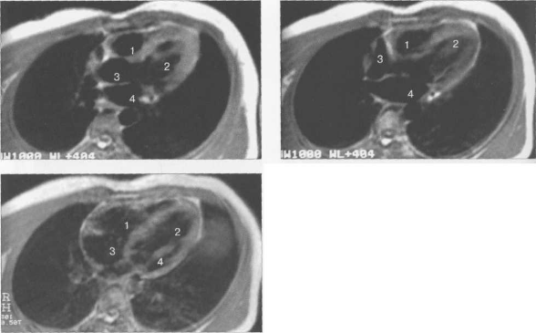 МРТ сердца. Четырехкамерные сечения.