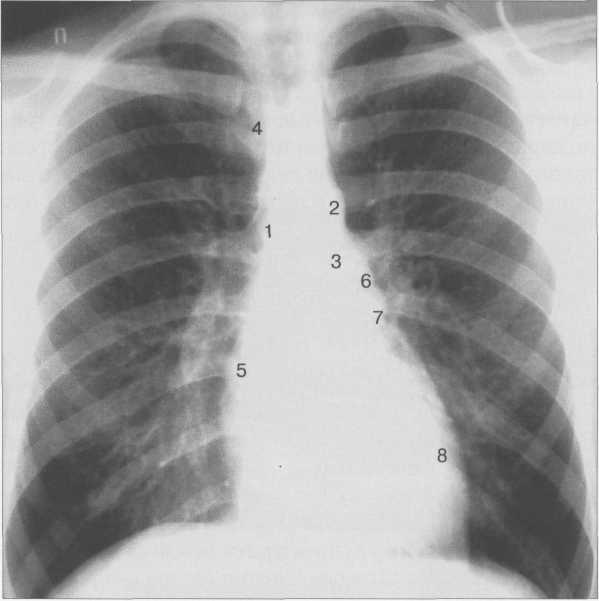 Рентгенограмма грудной клетки. Передняя проекция.