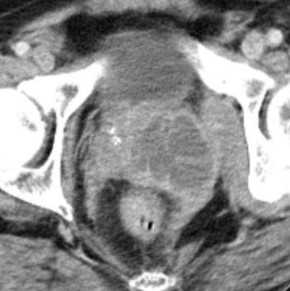 Абсцесс на томограмме