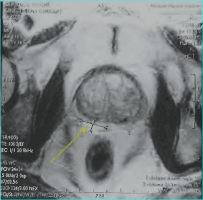 Лучевая диагностика заболеваний предстательной железы