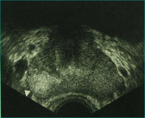 Лучевая диагностика заболеваний предстательной железы