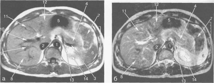 МРТ брюшной полости в аксиальной плоскости на уровне поджелудочной железы