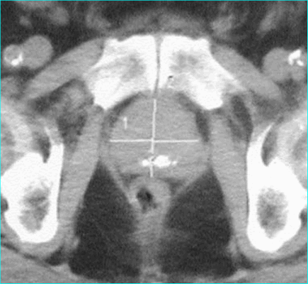 Лучевая диагностика заболеваний предстательной железы