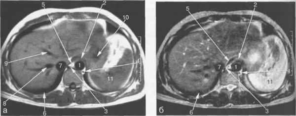 МРТ брюшной полости в аксиальной плоскости на уровне пищеводно-желудочного перехода.