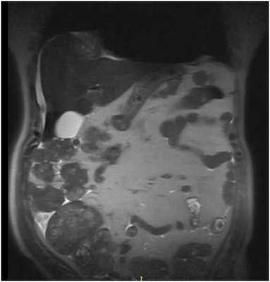 МРТ брюшной полости