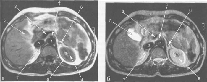 МРТ брюшной полости в аксиальной плоскости на уровне желчного пузыря.