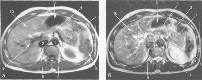 МРТ брюшной полости в аксиальной плоскости на уровне внутрипеченочных ветвей воротной вены.