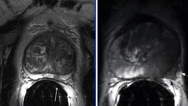Рак простаты на МРТ