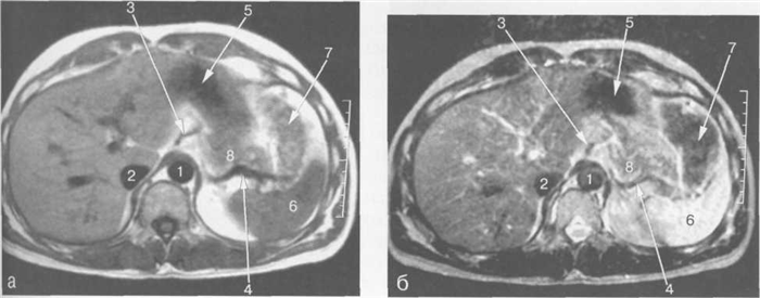 МРТ брюшной полости на уровне ворот селезенки.