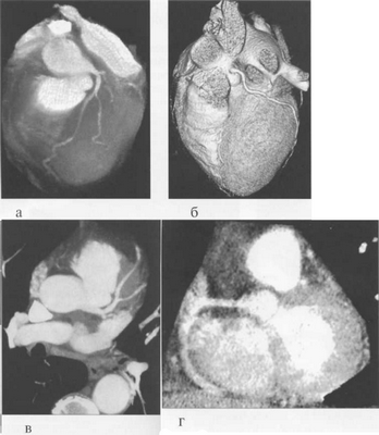 МСКТ-коронарограммы.