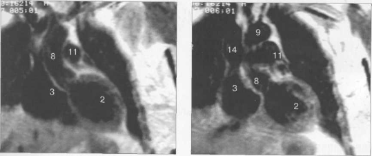 МРТ сердца. Фронтальные сечения.