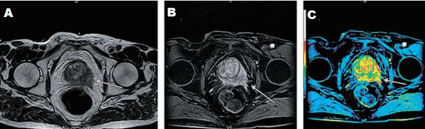 МРТ простаты
