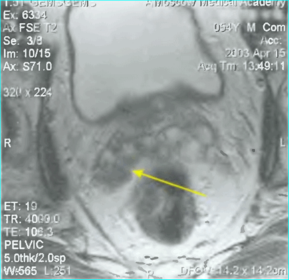 Лучевая диагностика заболеваний предстательной железы