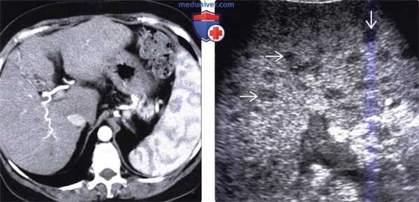 Рентгенограмма, КТ, МРТ, УЗИ при спленомегалии и гиперспленизме