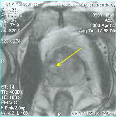 Лучевая диагностика заболеваний предстательной железы