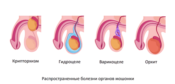 заболевания мошонки