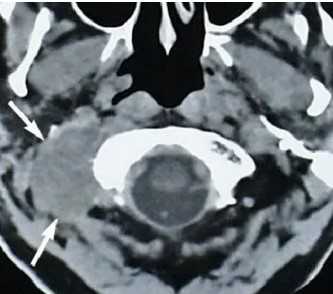 Увеличенные лимфатические узлы при раке простаты