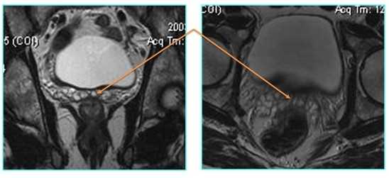 Лучевая диагностика заболеваний предстательной железы