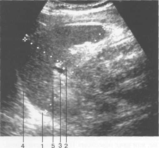 УЗИ селезенки, продольное сканирование