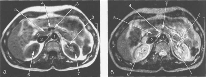 MPT брюшной полости в аксиальной плоскости на уровне головки поджелудочной железы.