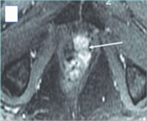 Лучевая диагностика заболеваний предстательной железы