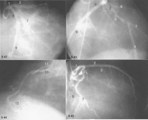 Левая коронарная артерия. правая коронарная артерия.