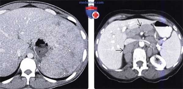 Рентгенограмма, КТ, МРТ, УЗИ при спленомегалии и гиперспленизме