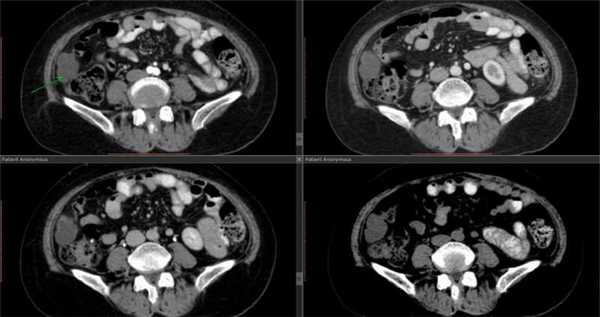 МРТ брюшной полости