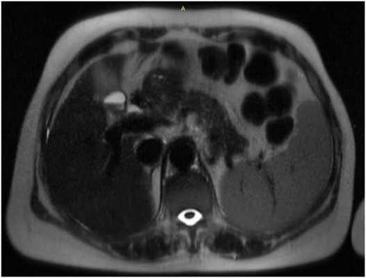 МРТ брюшной полости