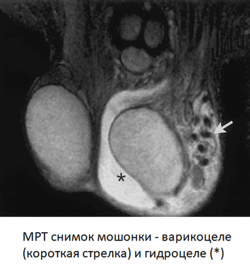 Варикоцеле на МРТ мошонки