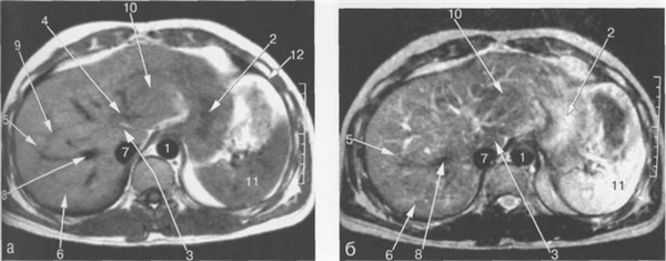 МРТ брюшной полости в аксиальной плоскости на уровне печеночных вен.