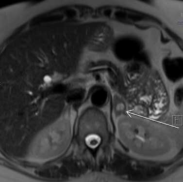 МРТ забрюшинного пространства