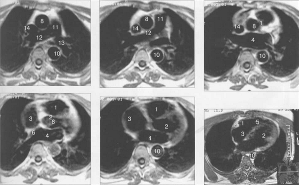 МРТ сердца. Аксиальная плоскость.