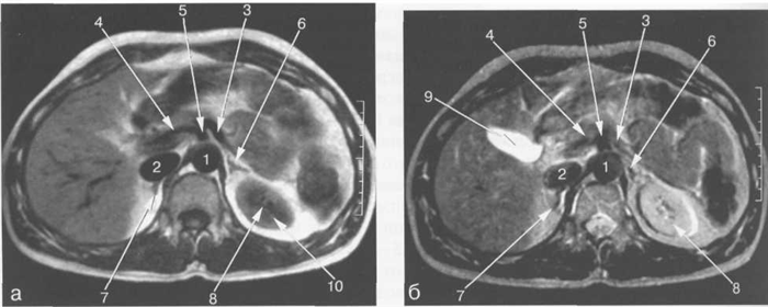 MPT брюшной полости в аксиальной плоскости на уровне надпочечников.